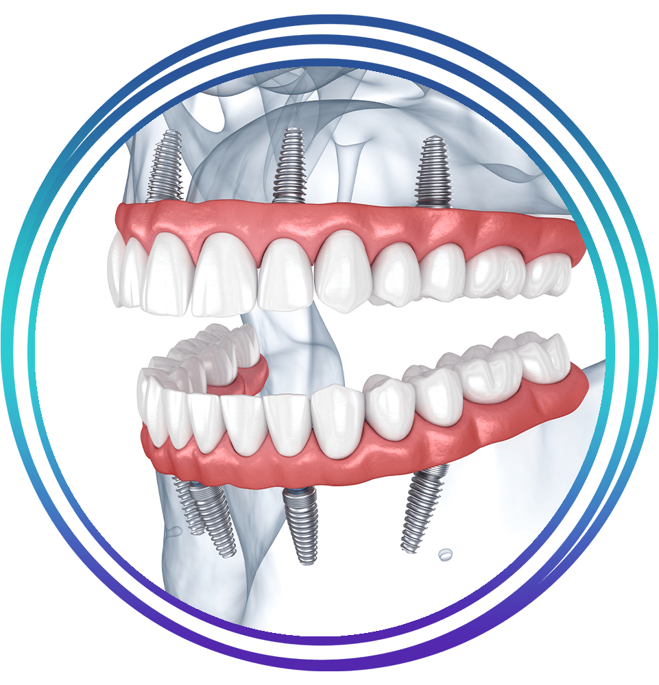 all on 4 dental implants