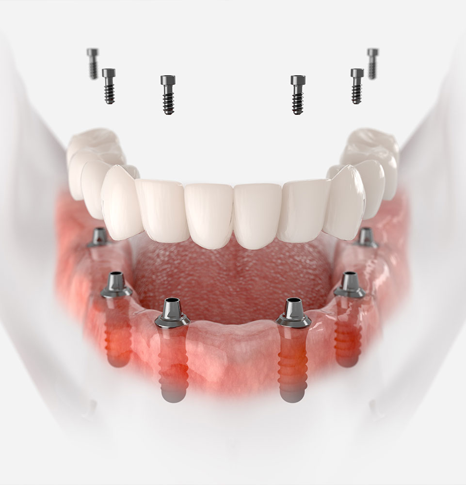 full arch fixed teeth