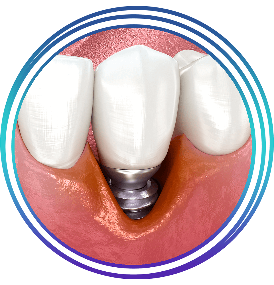 peri implantitis