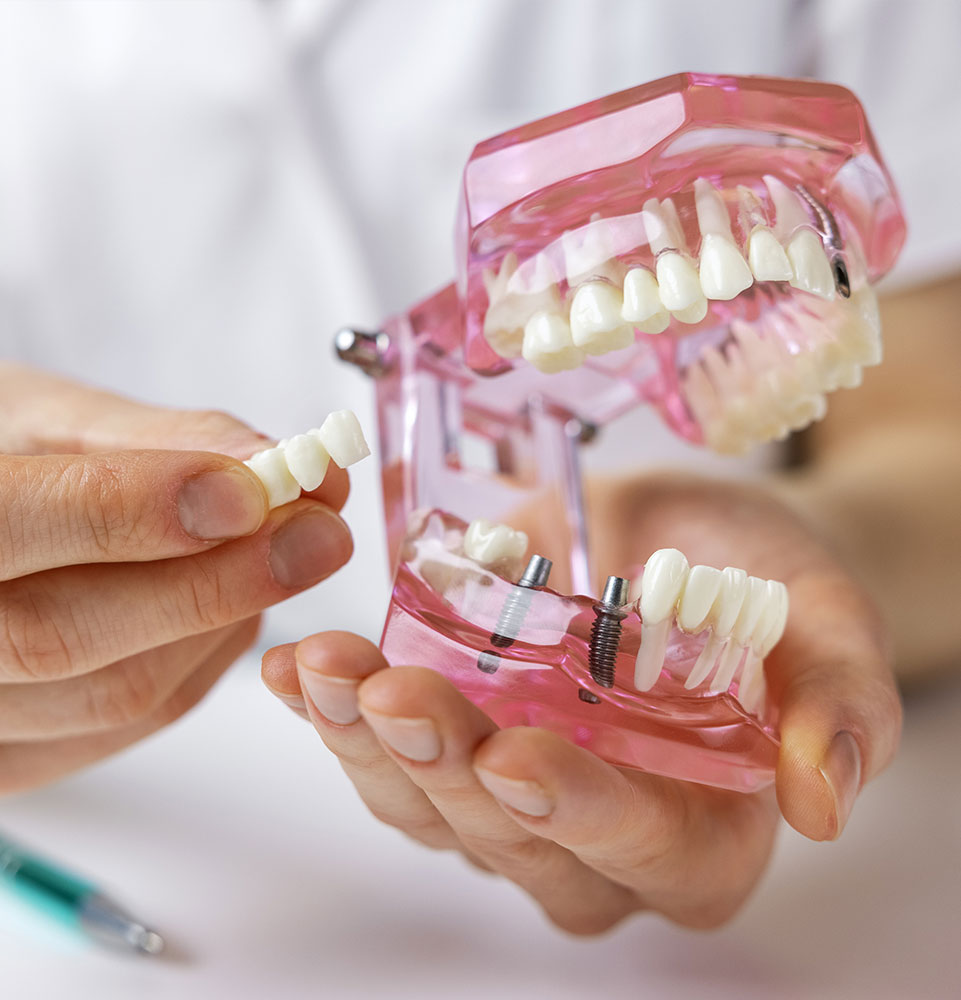 tooth replacement option