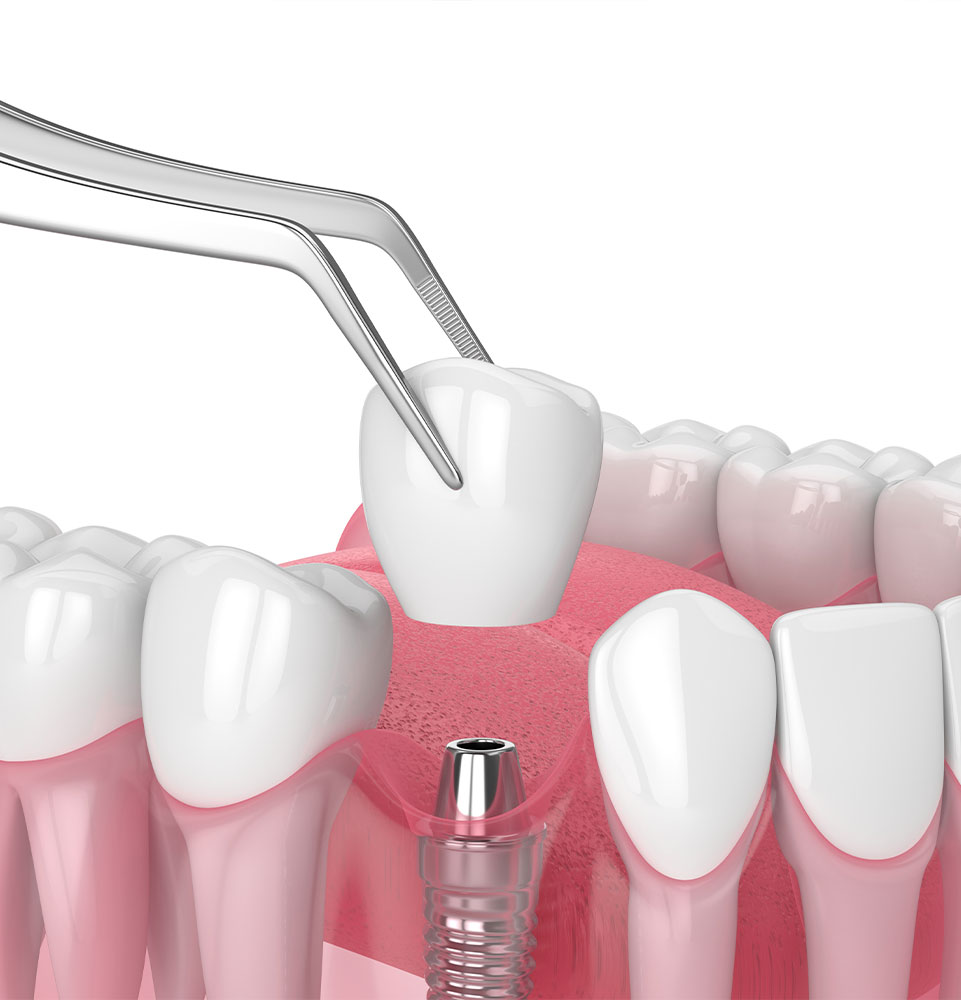 dental implant replacement surgery
